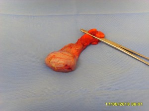 Removed left testicle - Tumour is not visible.