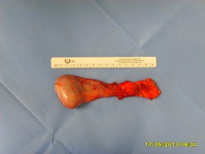 Removed left testicle - Tumour is not visible.