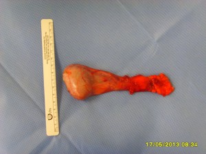 Removed left testicle - Tumour is not visible.